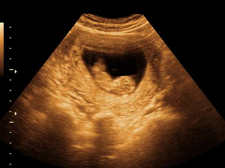 Snímek z ultrazvuku - ilustraní foto.