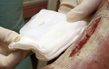 V brnnské Nemocnici Milosrdných bratí zaali v záí k odstraování odumelé tkán z ran pouívat larvy