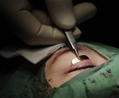Lékai v Motole vili dívce do víka zlatý plíek, aby oko mohla zavírat. Pokud by tak neuinili, do dvou let by oslepla.