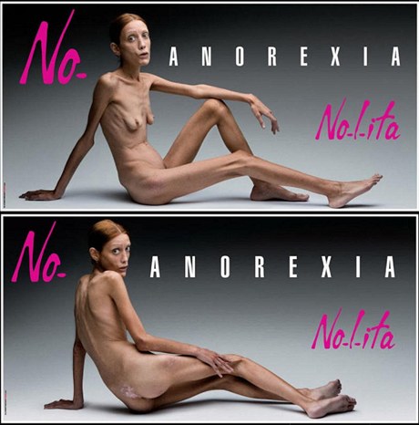 Kampa Ne anorexii