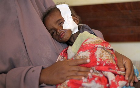 Hlad. V Somálsku dnes nejvíc trpí dti, hlavn podvýivou.