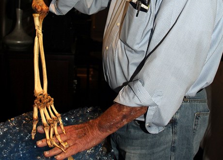 Dr. Sam Axelrad ukazuje kosti z ruky Nguyena Quang Hunga