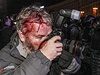 Mnoho lidí si odneslo z potyky krvavé zranní. Mezi nimi byl i fotograf agentury Reuters.