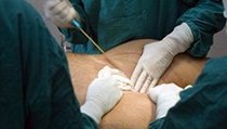 První změny ve tvaru postavy poznáte už po týdnu, ale definitivně se výsledek liposukce projeví až po čtyřech šesti týdnech. | na serveru Lidovky.cz | aktuální zprávy