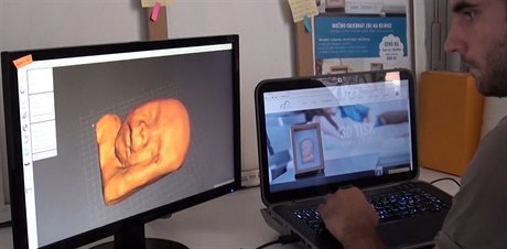 Díky 3D ultrazvuku je moné vymodelovat plastiku nenarozeného dítte.