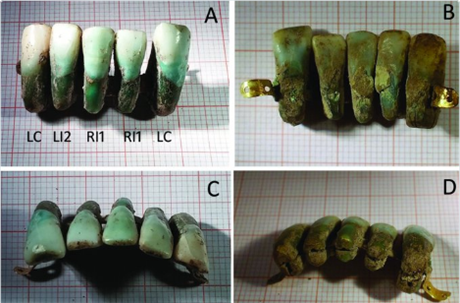 Pevratný nález. V Itálii nali zubní protézu starou tyi století