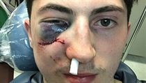 Neporval se, Zach Werenski jen schytal ránu pukem do oka. | na serveru Lidovky.cz | aktuální zprávy