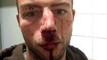 Michal Hlinka se vyfotil po ošetření v nemocnici. | na serveru Lidovky.cz | aktuální zprávy