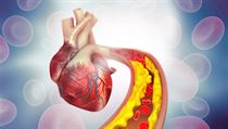 Cholesterol (ilustrační foto) | na serveru Lidovky.cz | aktuální zprávy