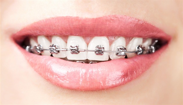 Zapomeňte na Invisalign. Stará dobrá rovnátka jsou opět v módě