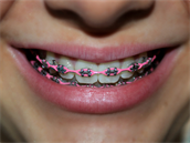 Rovnátka m��ou být r�zná, klidn� i barevná a módní.