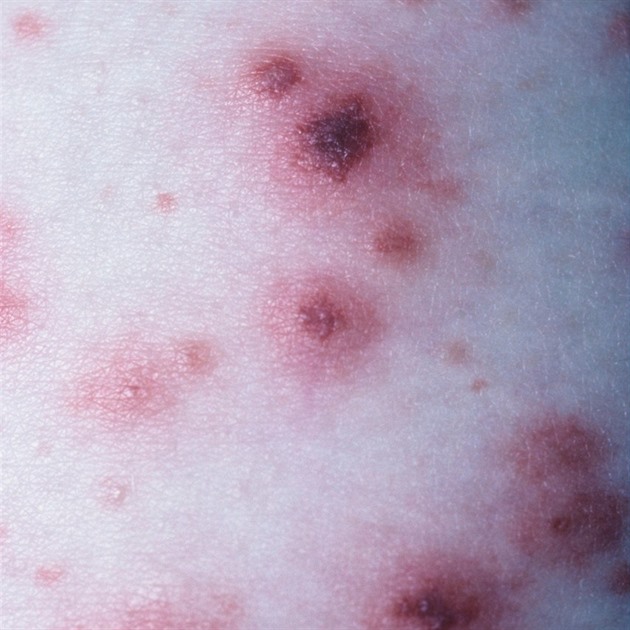 Gonorrhea Septicemia Sepsis.