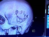 CT vyetení ukázalo lékam, e ech by ml pokraovat v chytání v helm.