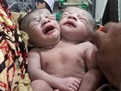 V Bangladéi se chudé vesniance narodilo dvouhlavé dít. Nadje, e peije...