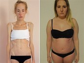 Mladá Australanka Gemma Walkerová porazila anorexii. Dívka v jeden okamik...