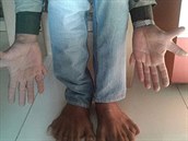 Díky polydaktylismu má Suthar na kadé konetin o dva prsty navíc.