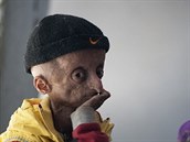 Progerií trpí na svt jen zhruba 250 dtí.