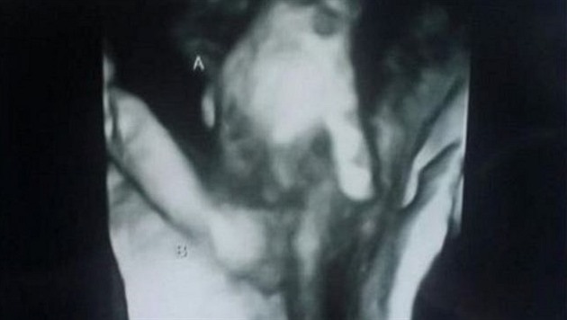 Fotka z ultrazvuku, která dojímá svt. Jaká je její story?
