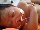 Malá holika, která zemela 37 týdn po narození kvli mikrocefalii.