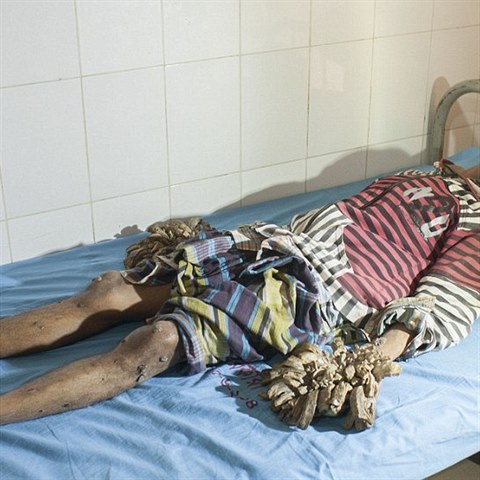 Pan Bajandar v nemocnici v Dhce.