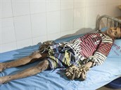 Pan Bajandar v nemocnici v Dháce.