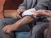 Ki na umlý penis doktoi transplantovali z Mohammadova zápstí.