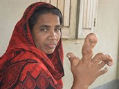 estaticetiletá Afroza Begumrom z Bangladée trpí záhadnou nemocí, díky které...
