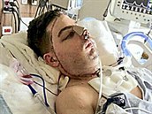 Mitch Hunter v roce 2011, kdy podstoupil transplantaci oblieje.