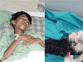 Patnáctiletý Mohd Zul Shahril Saidin z Malajsie nosil od narození v bie své...
