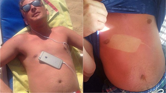 Britský turista usnul na plái s mobilem na bie. Opálil se i se rkou od...