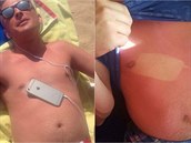 Britský turista usnul na plái s mobilem na bie. Opálil se i se rkou od...