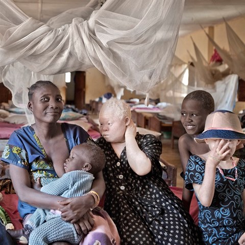 Krom albinismu trp nkte obyvatel azylovho centra i dalmi tlesnmi...