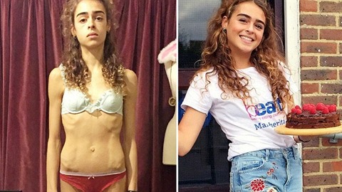 Margherita Barbieri (18) pemohla anorexii. Byly ale doby, kdy váila jen 25...