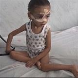 V Jemenu je spousta dt, kte se stali obt hladomoru.