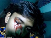 Akhilesh Raghuvanshi pláe krev, doktoi nevdí jak mu pomoci.