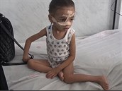 V Jemenu je spousta dtí, kteí se stali obtí hladomoru.