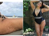 Tomu se �íká celulitida!