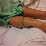 Bizarn operace umonila Gabi ohbat nohu i po operaci.
