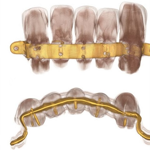 Zuby jsou spojen zlatm plkem.