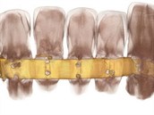 Zuby jsou spojené zlatým plíkem.