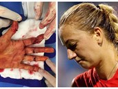 Petra Kvitová poprvé zvejnila fotku poezané ruky po napadení vloni v...