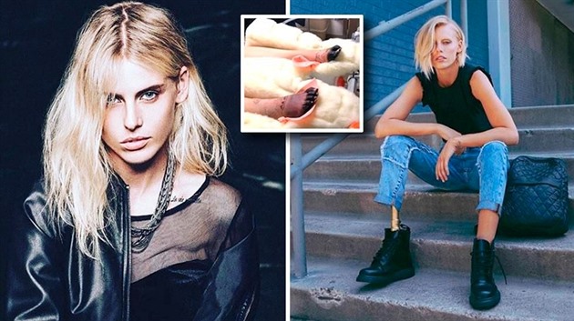 Modelka Lauren Wasser pila díky TSS o nohu