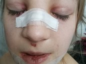 Dívka si po pádu zlomila nos a odtrhla si bradu od elisti.