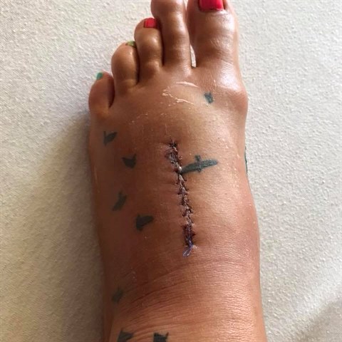Noha Moniky po operaci. Jizva j zhyzdila tetovn.