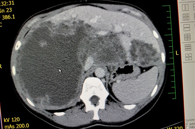 tyi pacienty nakaené velice vzácnou a ivotu nebezpenou nemocí  lií tasemnicí  léí v souasné dob odborníci z infekního oddlení Slezské nemocnice v Opav. Na obrázku snímek z CT.