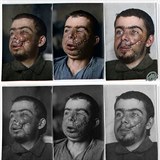 Voják po transplantaci části obličeje během první světové války.