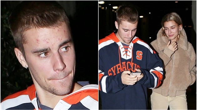 Na oblieji Justina Biebera vyrailo akné. Nemohou za nj drogy, ke kterým...