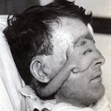 Walterovi Gillies odřízl kůži z těla, částečně ji nechal přirostlou a přišil mu...