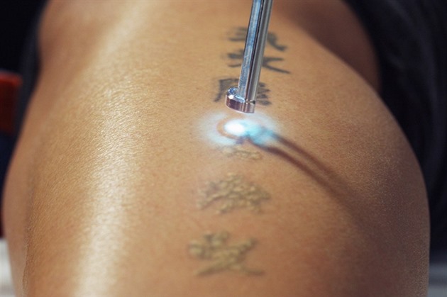 Tetování laser