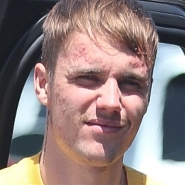 Justin Bieber m zjevn problmy s plet. Obliej m pln akn!